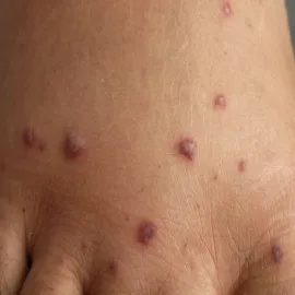 Grudki na skórze choroba Behçeta 