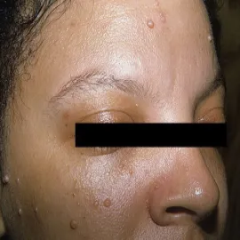 Grudki o barwie cieliste na twarzy