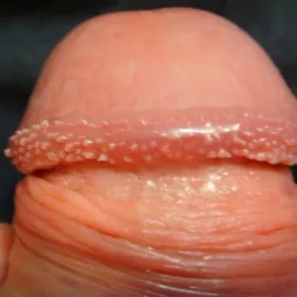 Grudki perliste prącia na koronie żołędzi 