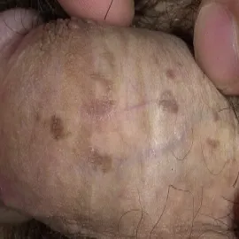 Grudkowatość bowenoidalna zdjęcie