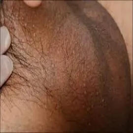 Grudkowatość bowenoidalna moszny