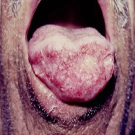 Grzybica choroba Gilchrista