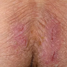 Grzybica między pośladkami