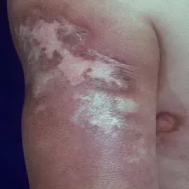 Grzybica północnoamerykańska choroba Gilchrista