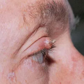 Guz na powiece rogowiak kolczystokomórkowy 