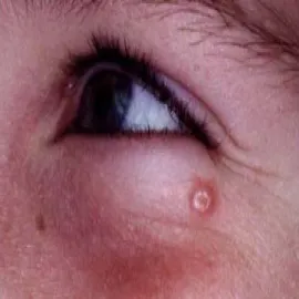 Guzek koło oka mięczak zakaźny