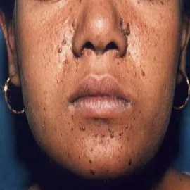 Guzki półkuliste na twarzy w kolorze skóry gruczolak łojowy