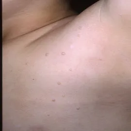 Guzki pod pachą u dziecka 