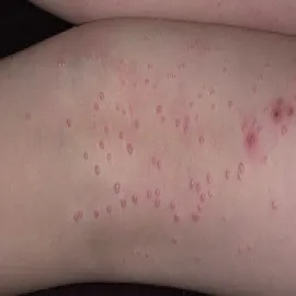 Guzki w mięczaku zakaźnym na skórze