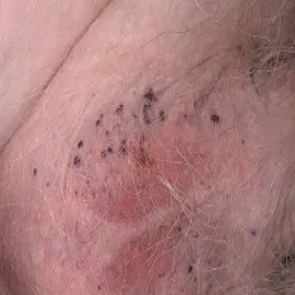 Guzki w okolicach intymnych kobiet rogowiec krwawy