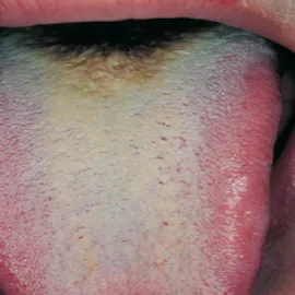 Język z ciemnobrązowym zabarwieniem 