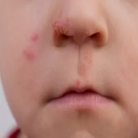 Jak wygląda liszajec u dziecka