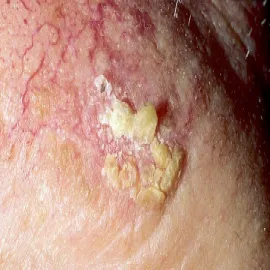 Jak wygląda rogowacenie słoneczne