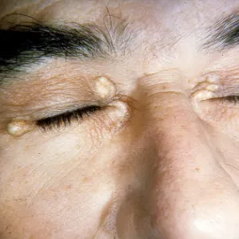 Kępki żółte objawy