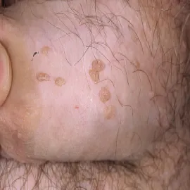 Kłykciny kończyste u mężczyzny