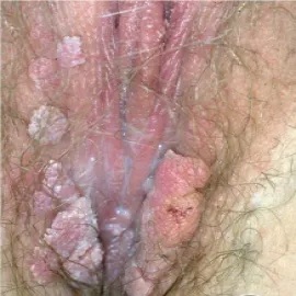 Kłykciny kończyste u kobiet