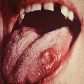 Kiła na języku 