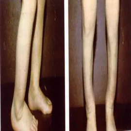 Kiła wrodzona deformacje stóp, nóg