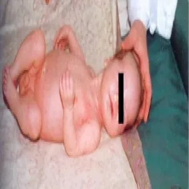 Kiła wrodzona u dziecka nieżyt nosa surowiczo-ropny