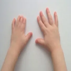 krótkie palce u rąk choroba brachydaktylia