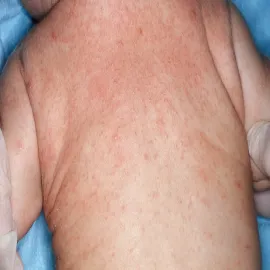 Krostki na plecach u dziecka świerzb