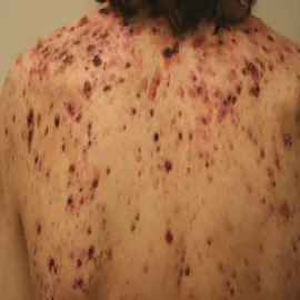 Krosty na ciele trądzik piorunujący