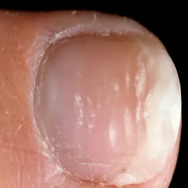 Leukonychia partialis