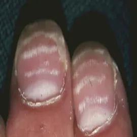 Leukonychia transversalis