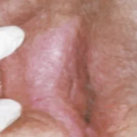 Leukoplakia sromu zdjęcie