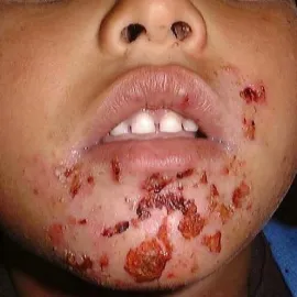 Liszajec na brodzie u dziecka