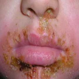 Liszajec wysypka koło ust