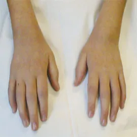 Młodzieńcze reumatoidalne zapalenie stawów objawy 