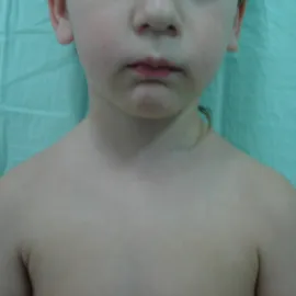 Młodzieńcze reumatoidalne zapalenie stawów 