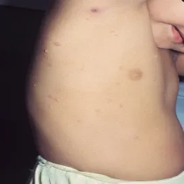 Mięczak zakaźny grudki na skórze