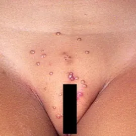 Mięczak zakaźny miejsc intymnych u dzieci