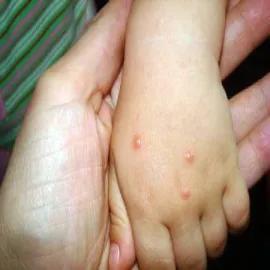 Mięczak zakaźny na dłoni u dziecka