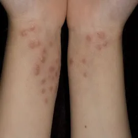 Mięczak zakaźny na nadgarstkach