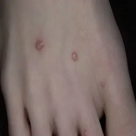 Mięczak zakaźny na stopie