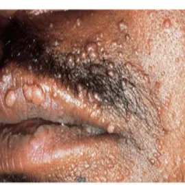 Mięczak zakaźny na twarzy 