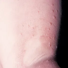 Mięczak zakaźny objawy