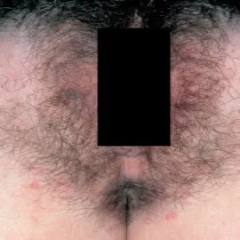 Mięczak zakaźny okolice intymne u kobiet