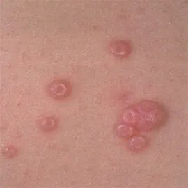 Mięczak zakaźny okrągłe guzki