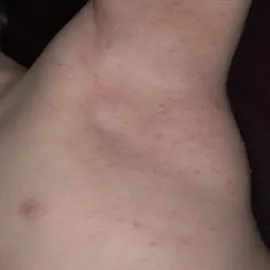 Mięczak zakaźny pod pachą