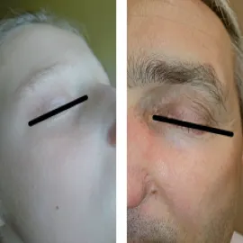 Mięczak zakaźny w obrębie powiek