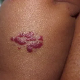 Naczyniak prosty zdjęcie