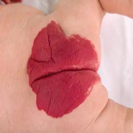 Naczyniak rozgałęziony zdjęcie