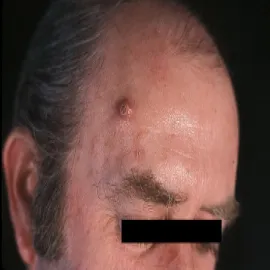 Narośl guzek na czole rogowiak kolczystokomórkowy 