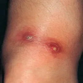 Niesztowica gronkowiec złocisty 