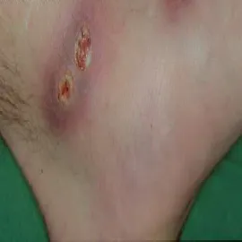 Niesztowica paciorkowiec ropotwórczy  