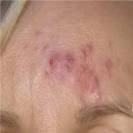 Nużeńce ludzkie na czole nużyca